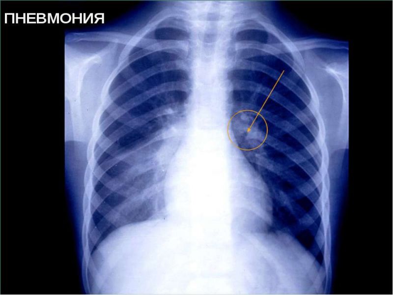 86 больных пневмонией находятся в тяжелом состоянии в Алматинской области